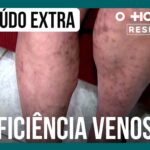 cirurgiao-vascular-explica-quais-sao-as-causas-da-insuficiencia-venosa-|-o-hospital-responde