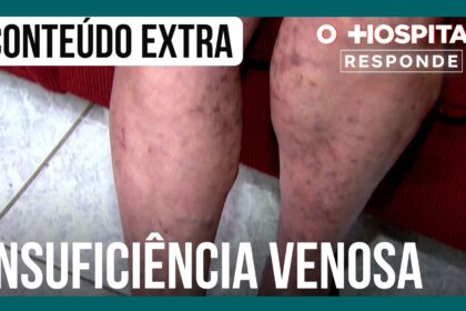 cirurgiao-vascular-explica-quais-sao-as-causas-da-insuficiencia-venosa-|-o-hospital-responde