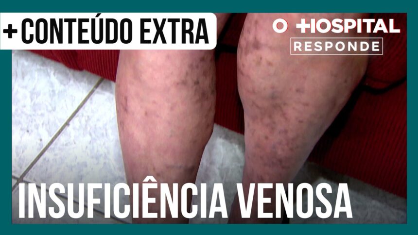 cirurgiao-vascular-explica-quais-sao-as-causas-da-insuficiencia-venosa-|-o-hospital-responde