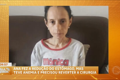 mulher-precisa-reverter-bariatrica-apos-perder-muito-peso-e-desenvolver-anemia