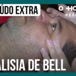 fernanda-gentil-e-diagnosticada-com-paralisia-de-bell;-entenda-o-que-e-a-doenca-|-o-hospital-responde